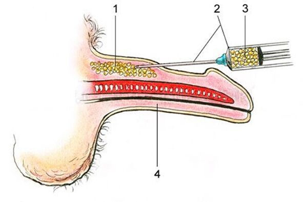 Lipofilling - introducerea de țesut adipos în axul penisului