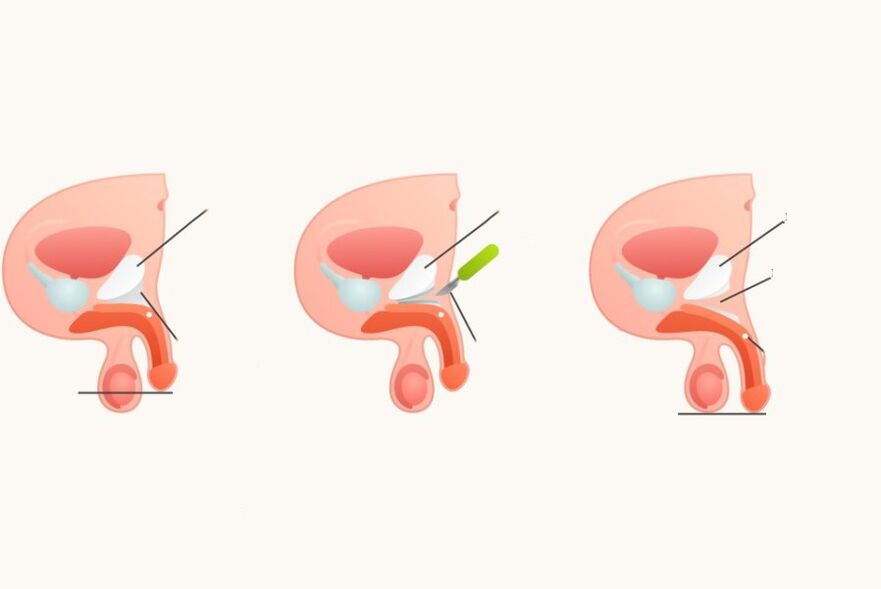 Ligamentatomie pentru creșterea penisului