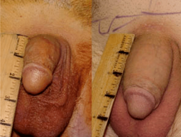 Înainte și după lipofilling și implantare de gel