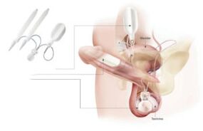 inserarea implanturilor în penis
